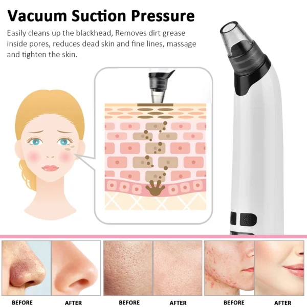 Beauty Electric Blackhead Remover Facial Cleaner Black Point Vacuum Suction Black Head Dots Remover Extractor Skin Care Tools - Image 2